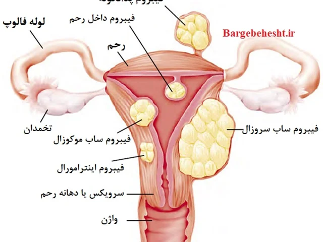 علل ایجاد فیبروم و میوم رحمی و راه های پیشگیری و درمان