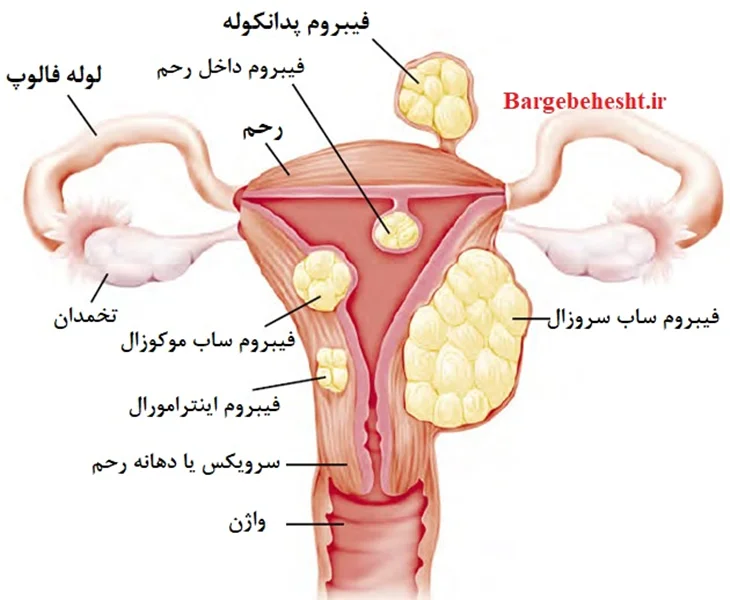 علل ایجاد فیبروم و میوم رحمی و راه های پیشگیری و درمان